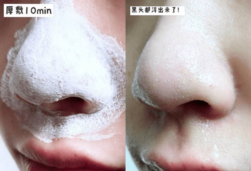 黑头洗完脸别擦水乳！漏掉这一步，难怪你黑头粉刺越来越多！