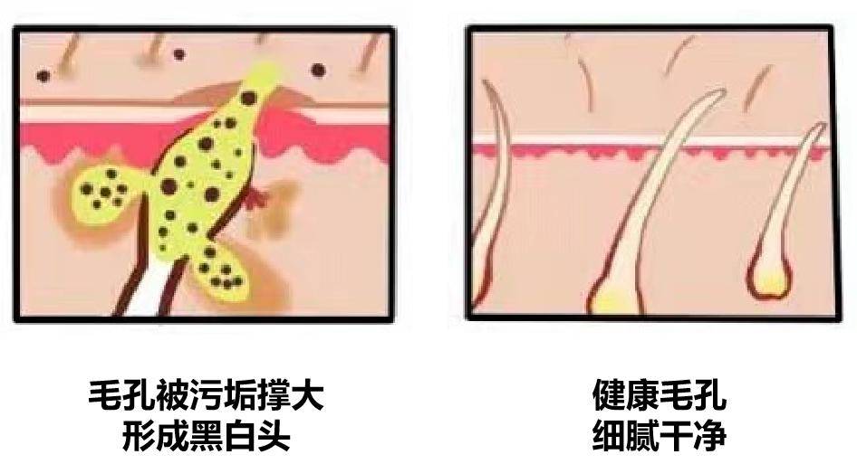 黑头洗完脸别擦水乳！漏掉这一步，难怪你黑头粉刺越来越多！