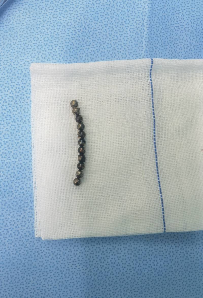 杨六成|别给孩子玩磁力珠！3岁男童误吞11颗磁力珠 致4处肠穿孔