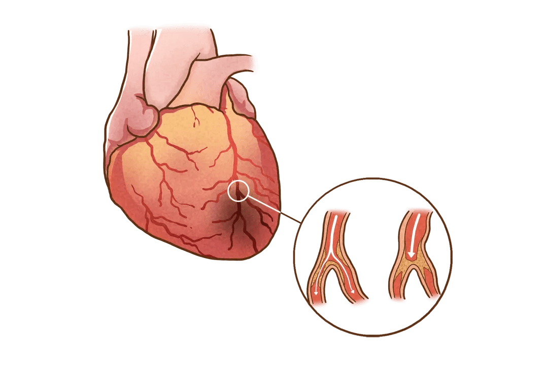 胸痹图片图片