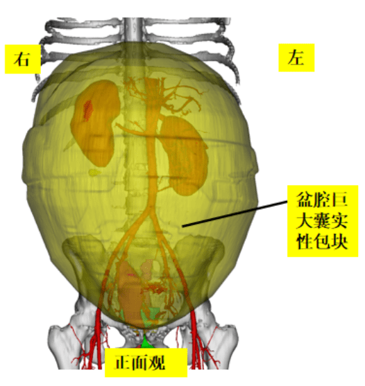 手术|25岁女子肚大如足月孕妇 竟是50斤重的卵巢肿瘤在作祟