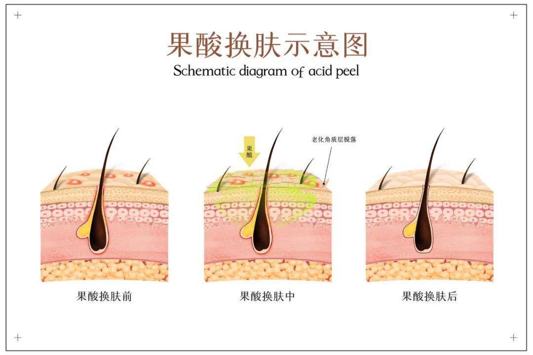 这种简单的原理换成"科学的说法,就是果酸产品可以减少皮肤角质的聚