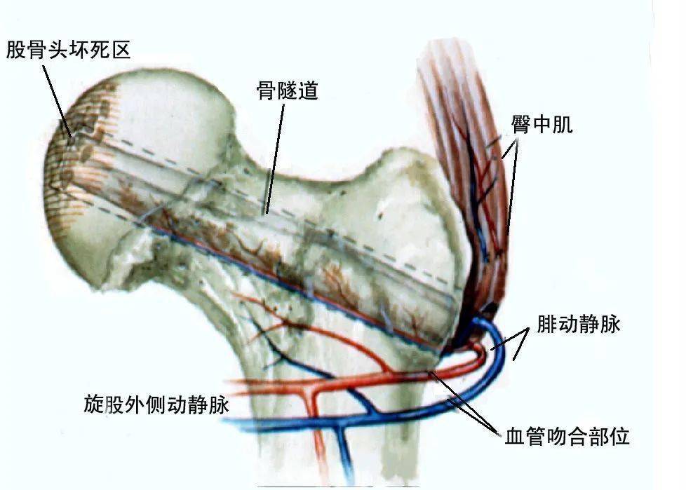 【健康医声】股骨头缺血性坏死知多少?_髋关节