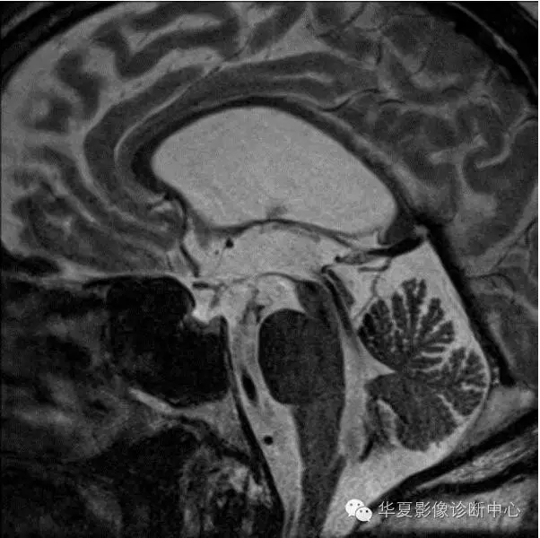 畸形|這 6 種典型影像征象的病變你都認識了嗎