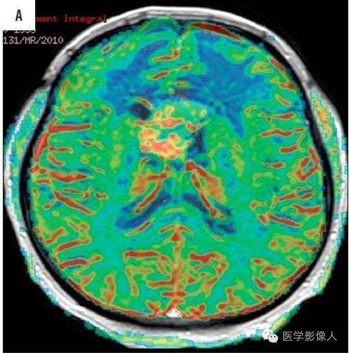 黄素环|脑内T2WI上低信号病变大致分为8大类【总结】