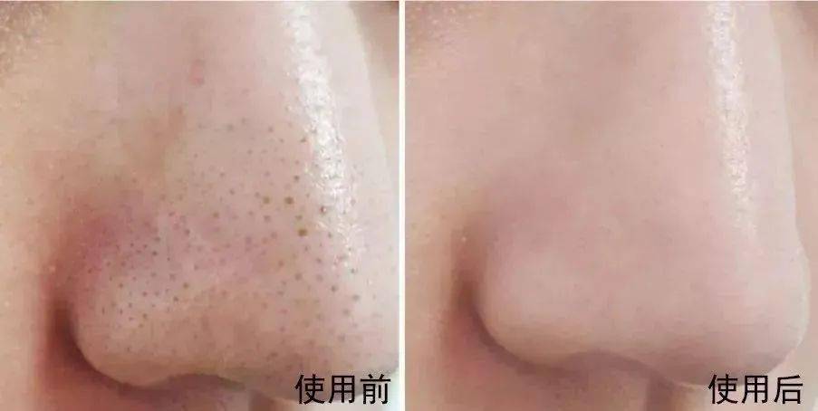 黑头获得世界品质评鉴大奖的洁颜泥，日本模特、艺人大爱，黑头、角质、粉刺用它都能搞定！