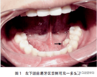 专科查体:颌面部左右基本对称,左下颌前磨牙区舌侧可见一多生牙,无