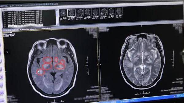 球菌|警惕！女子杀鸡之后失去意识，竟是患上致死率40％的重疾