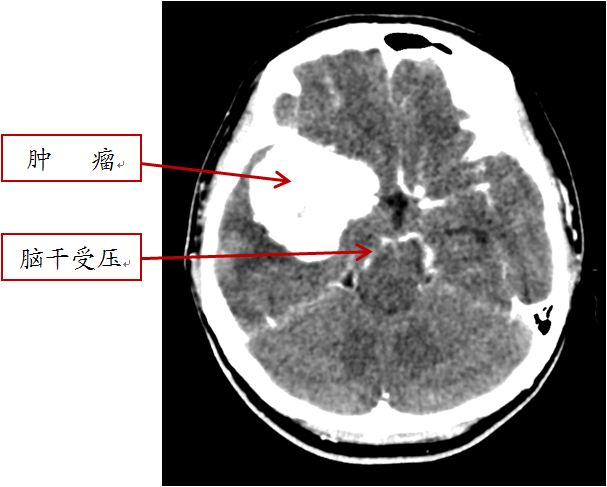 女子产后反复头痛 呕吐 一查竟揪出巨大脑膜瘤 李小姐