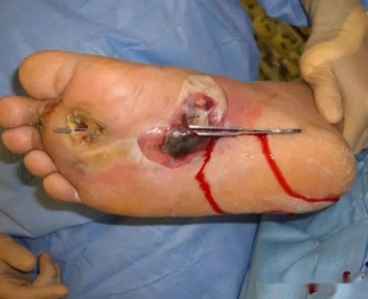 不同类型的伤口图片,认识一下(中)