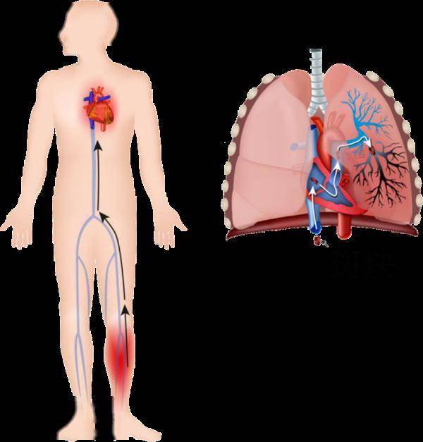 感觉|它是心梗、脑梗的元凶，更容易找上这些人
