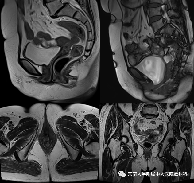 盆腔臟器脫垂mri影像