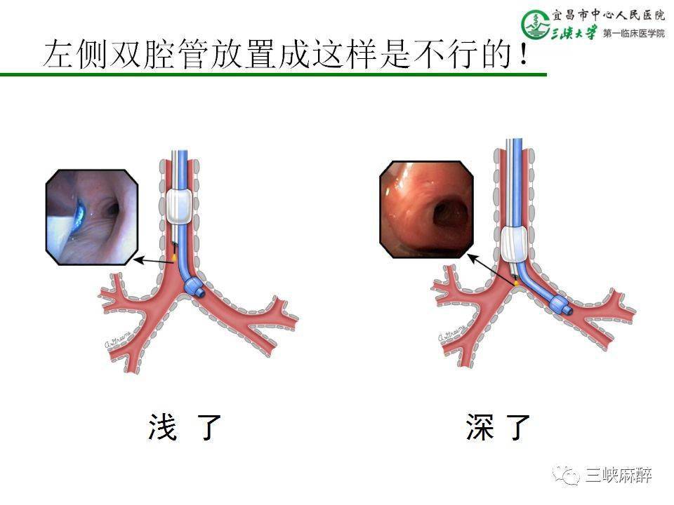 双腔管插管临床使用技巧宜昌市中心人民医院麻醉科