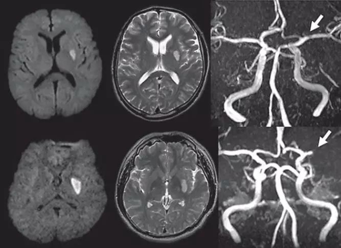 大脑|“腔隙性脑梗死”这个临床诊断，可以慢慢作古了