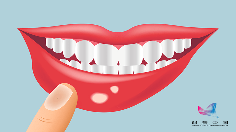 头颈部|一女子反复口腔溃疡被诊断为舌癌！医生：超过这个时间要赶紧就诊……