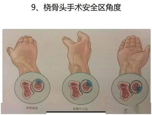 當冠狀突骨折>50%時,測量尺骨張開角可減小到0°,此時會嚴重影響肘