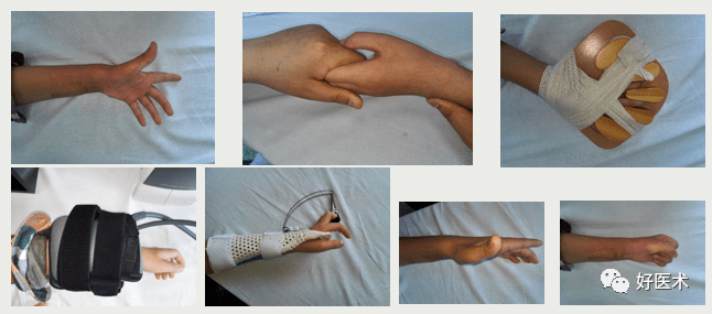 手部外伤术后康复方案及技巧一次性讲清楚