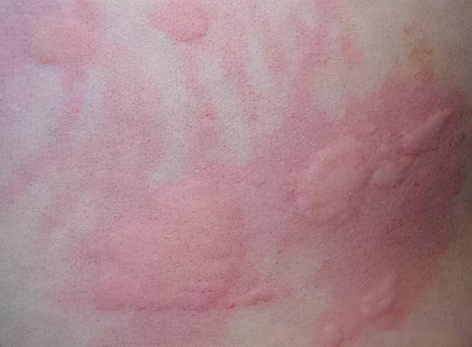 或者衣服牵拉了一下,就起一大片疙瘩,不仅看着难受,而且越抓越痒,越痒