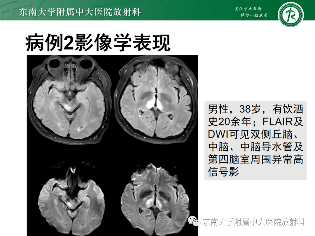 wernicke脑病影像表现