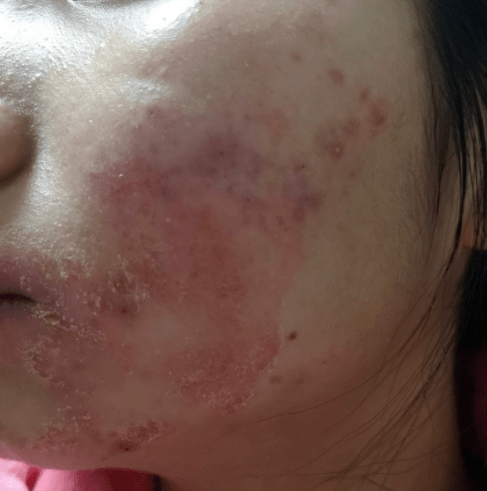 补充全国皮肤科榜首的华山医院，一个面霜做了3年，推迟又推迟
