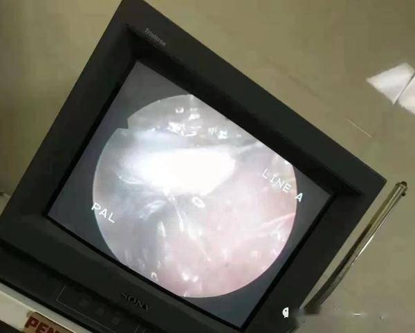 检查|毛骨悚然！老奶奶耳朵内藏了20余条蝇蛆，而且全都是活的