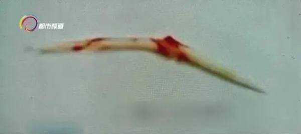 食道|警惕！鱼刺卡喉险丧命？就是因为用了这个“土办法”……