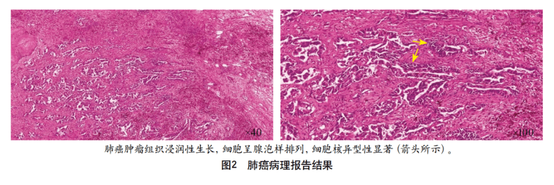 综合征|以多流域脑梗死为特征的肺癌继发特鲁索综合征1例并文献复习