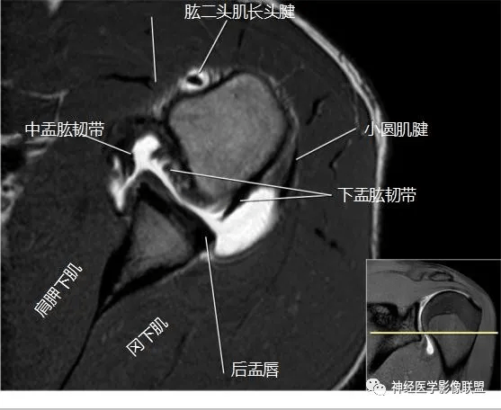 肩关节韧带mri解剖图图片