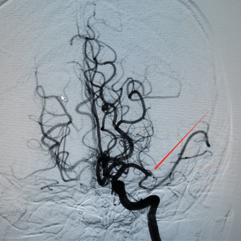 脑血管|18岁年轻小伙突发脑中风 广医三院开辟绿色通道与时间赛跑