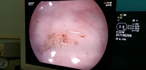 小青|爱吃这种美食，女孩肠道内布满活虫！很多人都吃过