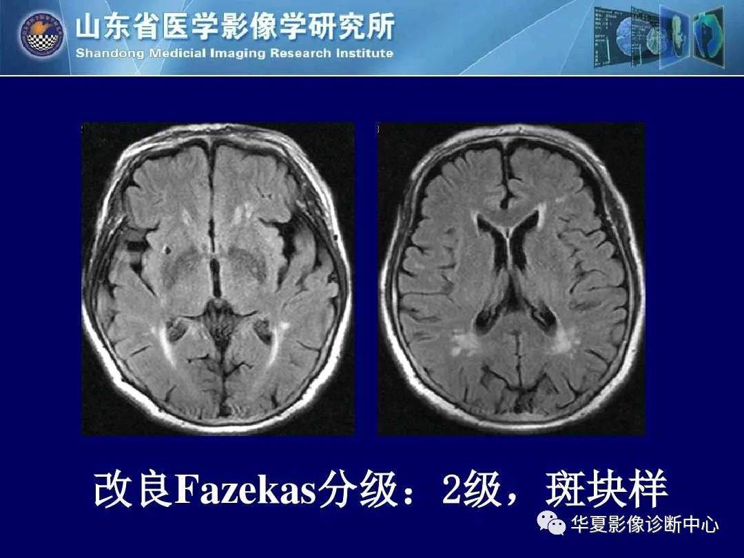 诊断|缺血性脑血管病的影像诊断