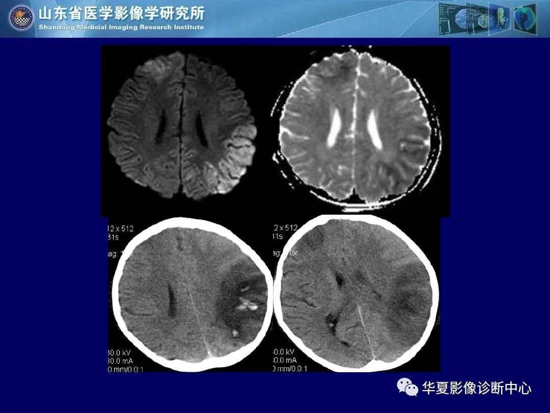 诊断|缺血性脑血管病的影像诊断