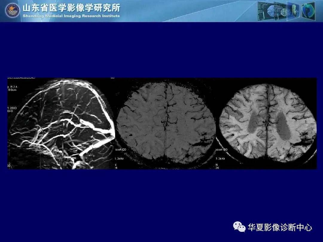 诊断|缺血性脑血管病的影像诊断