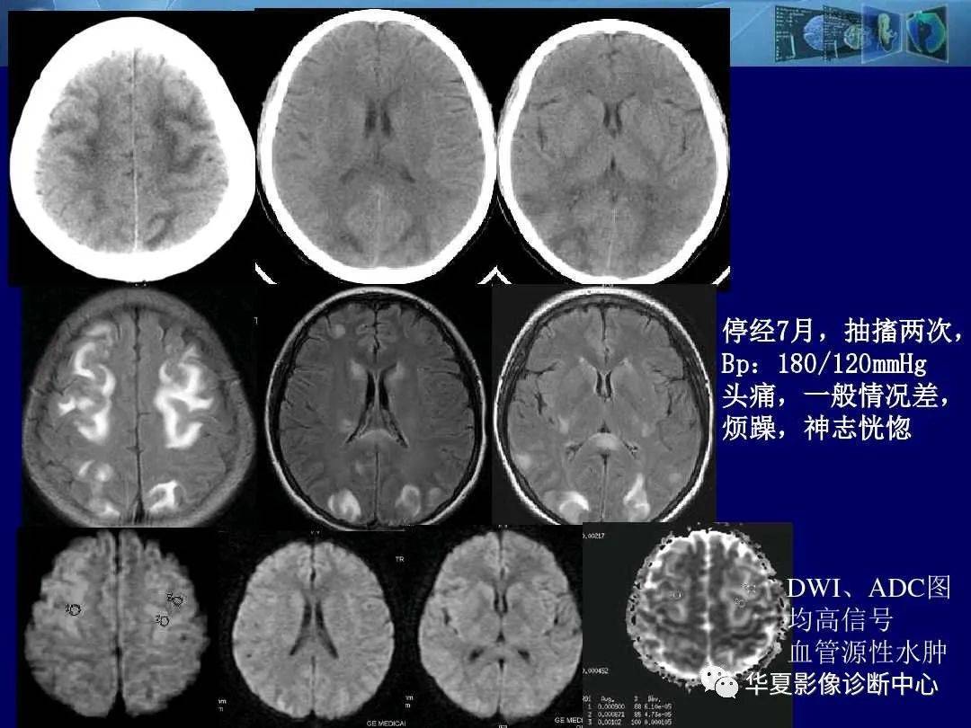 诊断|缺血性脑血管病的影像诊断