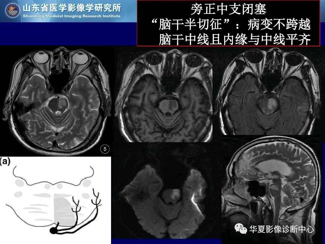 诊断|缺血性脑血管病的影像诊断