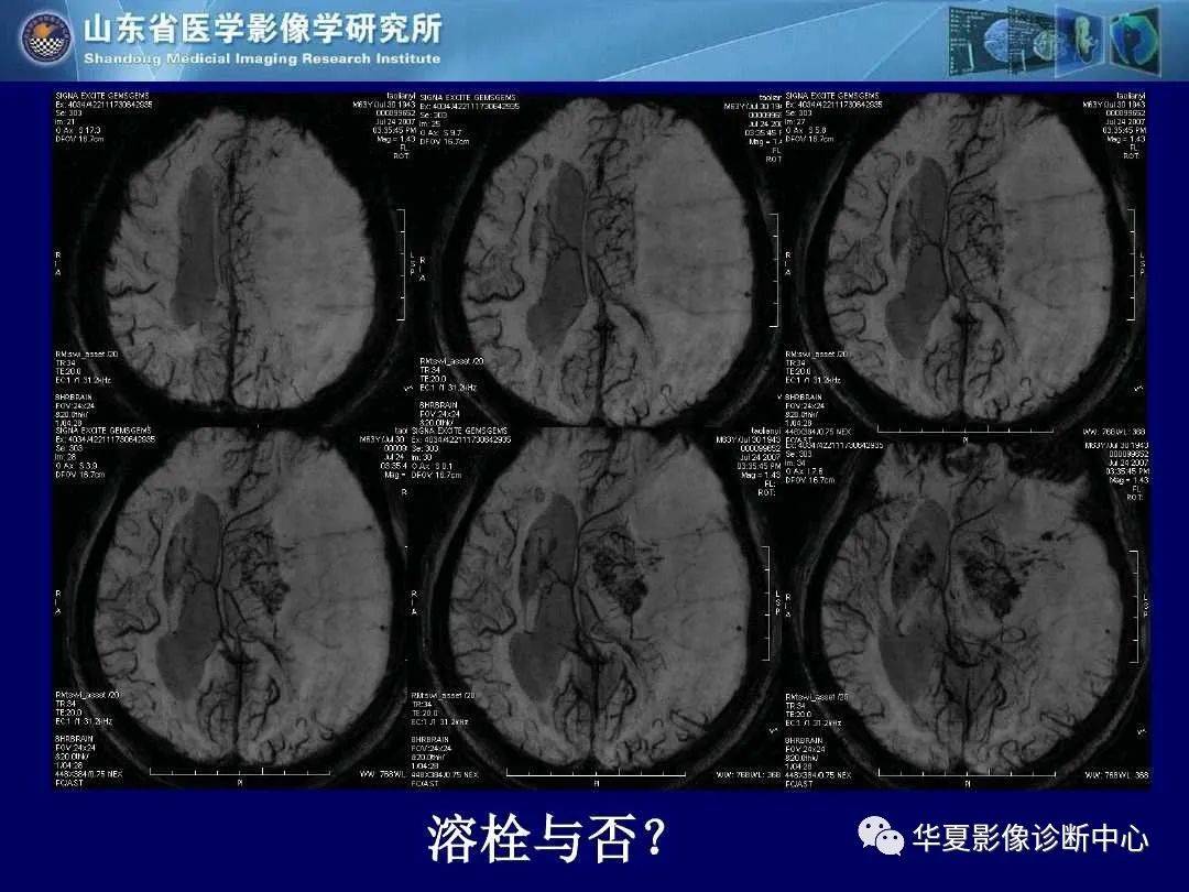 诊断|缺血性脑血管病的影像诊断