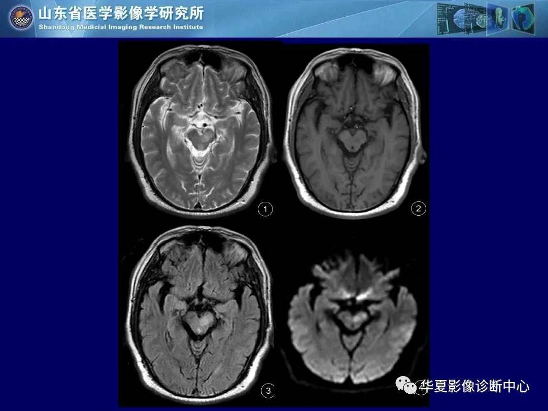 诊断|缺血性脑血管病的影像诊断