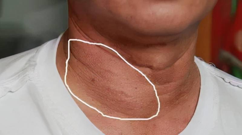 甲状腺正常的脖子形状图片
