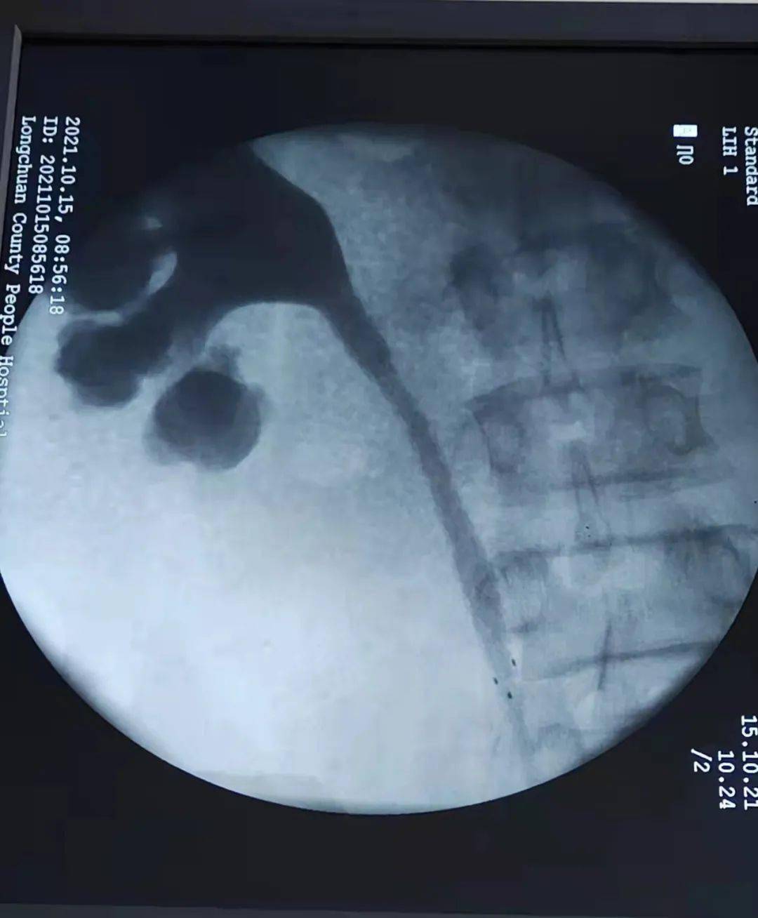 泌外新技术龙川县人民医院成功开展河源市首例输尿管狭窄球囊扩张