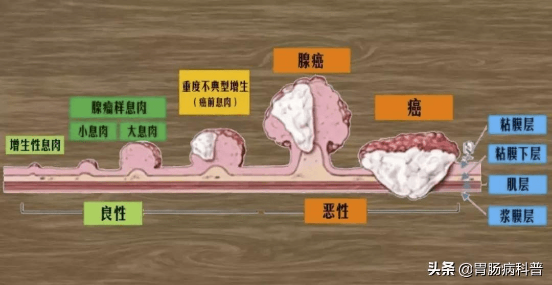 结肠息肉癌变模型图片