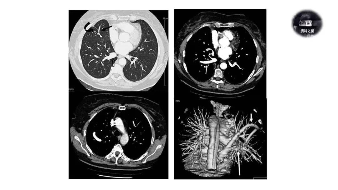 鉴别诊断:肺静脉曲张vs avm责任编辑:李玉佳胸科之窗欢迎您的加入长按