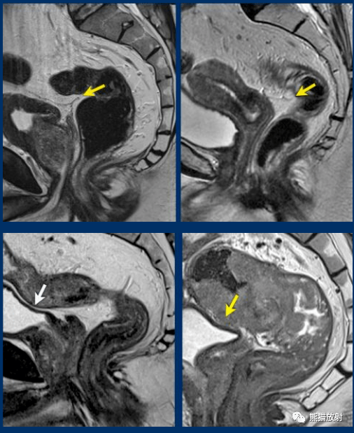 直肠癌mri:精彩示例,易学易懂