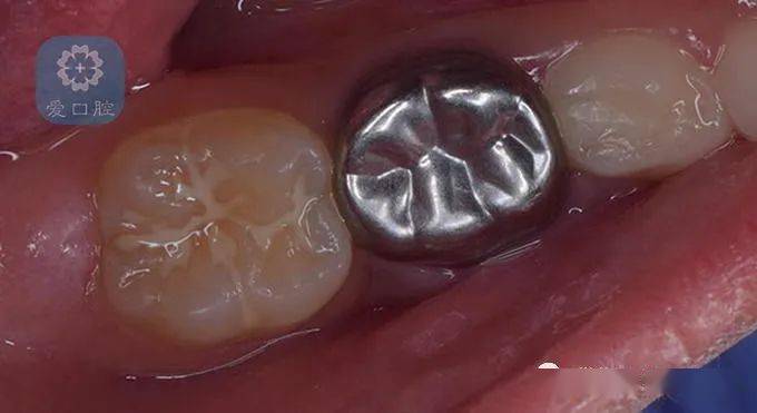 关于儿童乳牙预成冠的临床应用详解看这里