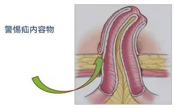 肠造口脱垂图片