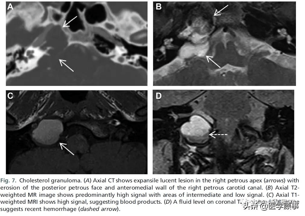 综述岩尖病变的影像
