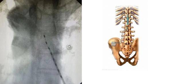 疫苗|广东一男子身上“生蛇”，检查结果惊出冷汗！医生紧急提醒