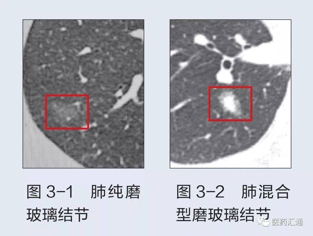 體檢查出磨玻璃結節就是癌?到底要緊不?_概率