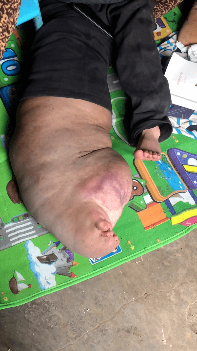 被网友们称为"象腿男孩"让人看到忍不住心疼差不多有40斤重右腿出现