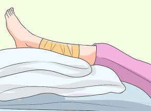 肢体骨折后患肢抬高你做对了吗