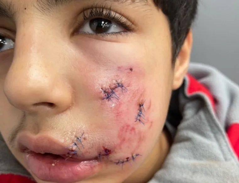 不忍直视多伦多知名武术老师的宠物狗咬伤13岁男孩脸颊